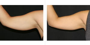 Coolsculpting arms