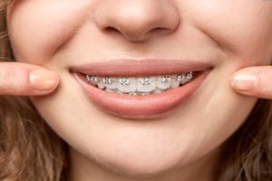 braces tooth extraction