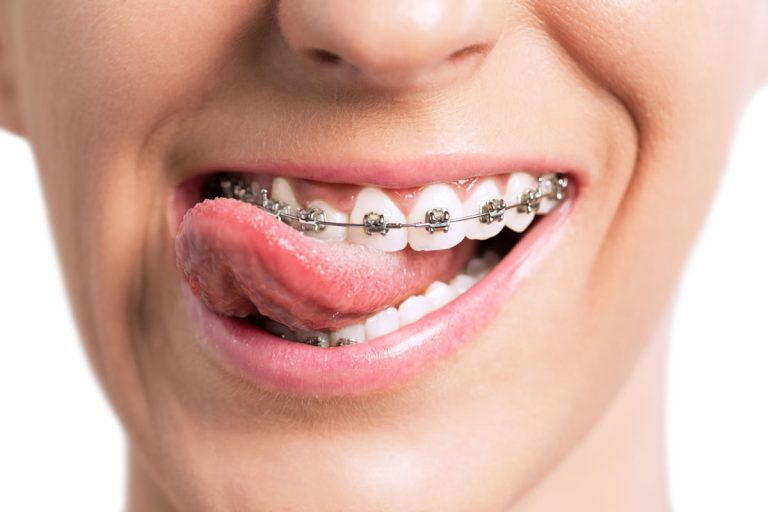 Orthodontic Aftercare: Maintaining Your Results with Munich’s Experts