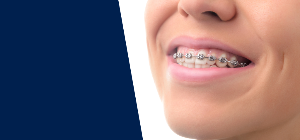 Align Braces Clinics