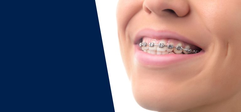 Align Braces Clinics: Achieve a Perfect Smile with Advanced Orthodontic Solutions
