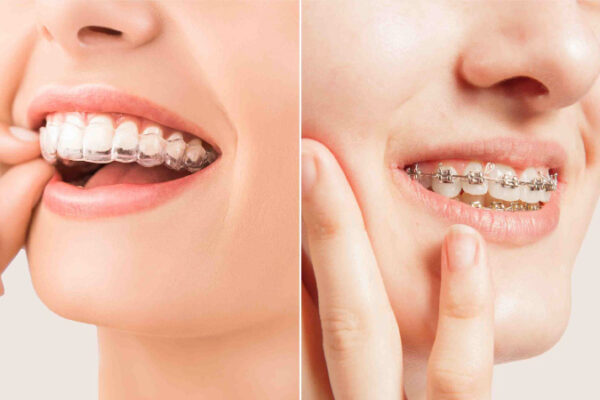Invisible Braces
