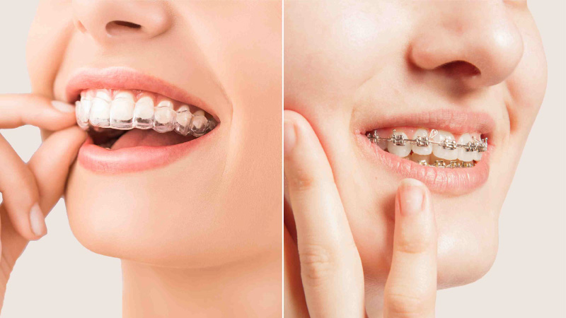 Invisible Braces