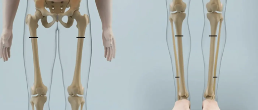 Limb Lengthening