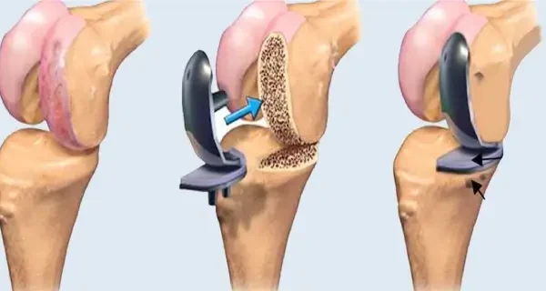 Preparing for Knee Replacement Surgery in India: A Step-by-Step Patient Guide