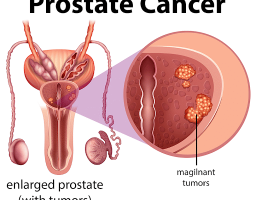 Prostate Cancer