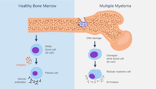 Myeloma Treatment